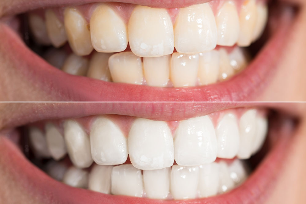 5 Effective Ways to Whiten Teeth at Home