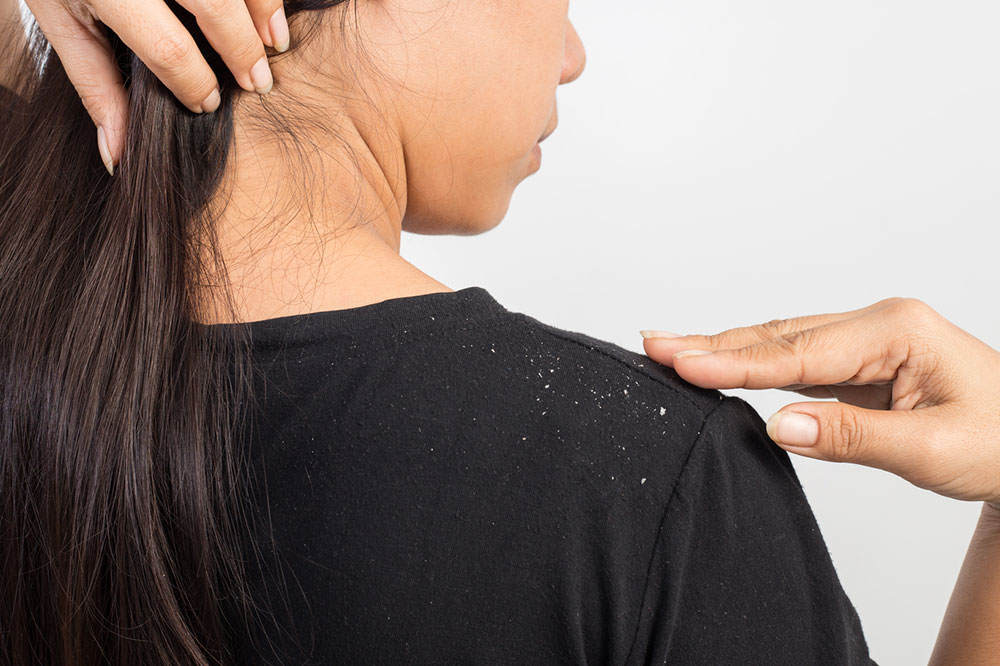 5 Remedies for Dandruff and Flakes