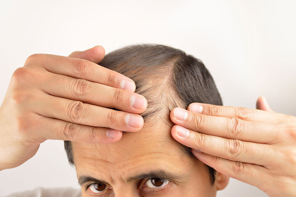 Home Remedies to Try to Prevent Hair Loss