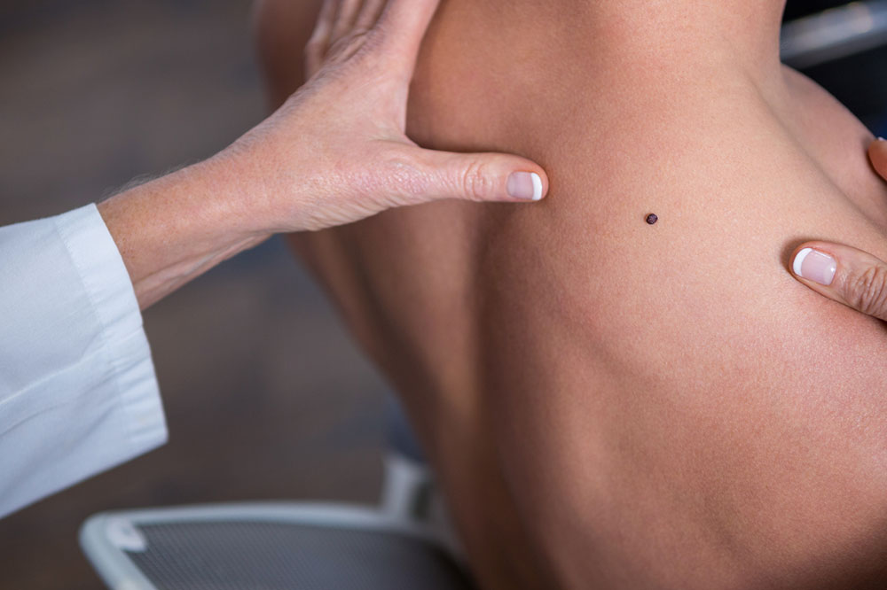 Prevention, Symptoms, and Effective Treatments for Melanoma